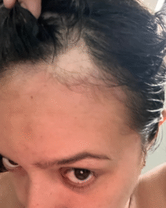 Zona frontal del cuero cabelludo con pérdida de cabello por alopecia areata.