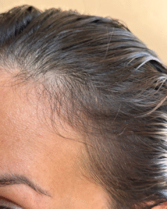Fotografía de recuperación visible tras alopecia areata con crecimiento de nuevo cabello.